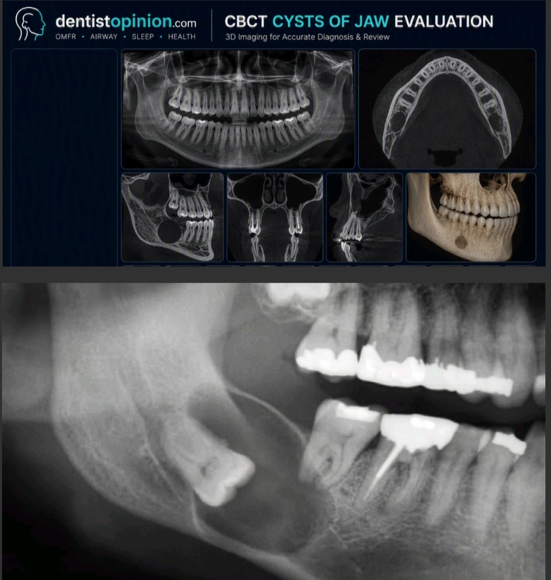 Cysts of the Jaw