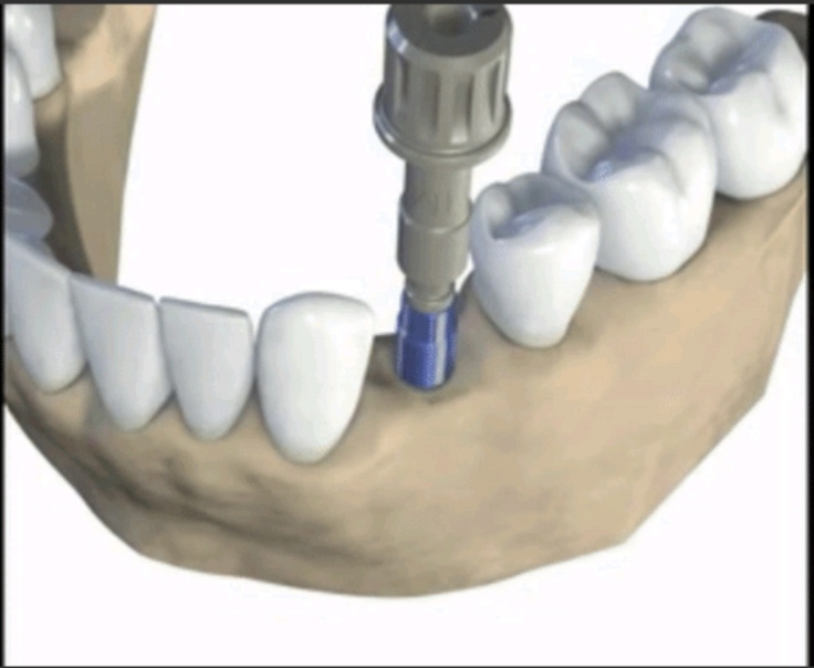 Implant Planning